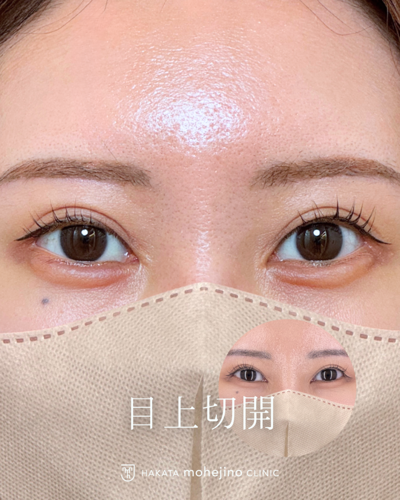 目上切開 | CASE | 博多もへじのクリニック