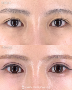 もへじの自然癒着法+傷の目立ちにくい目頭切開Z法
