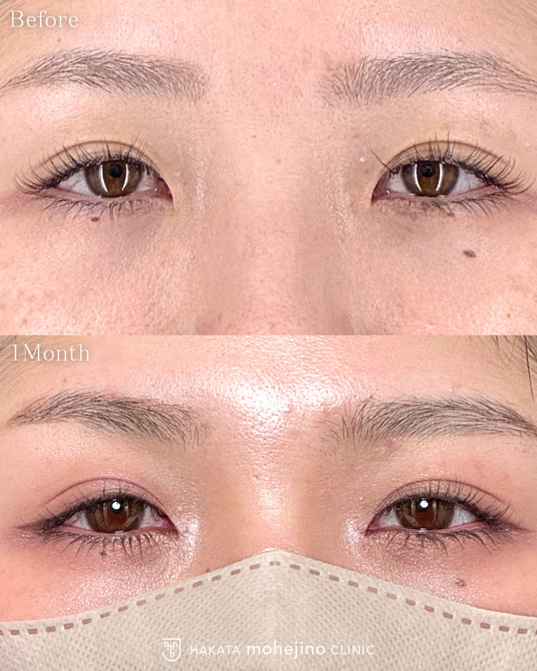 傷の目立ちにくい目頭切開Z法 | CASE | 博多もへじのクリニック |