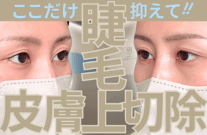 睫毛上皮膚切除とは？ダウンタイムや眼瞼下垂との違いを徹底解説