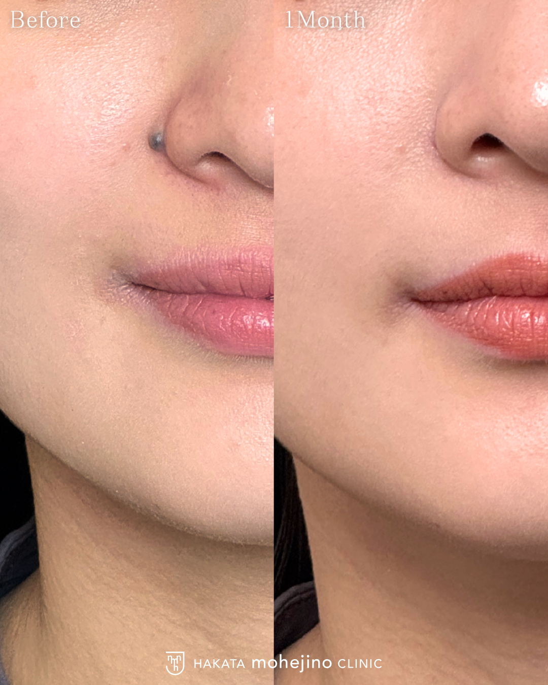 ほくろ除去 | CASE | 博多もへじのクリニック |