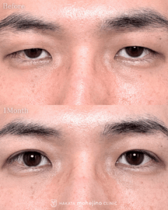 眼瞼下垂症手術