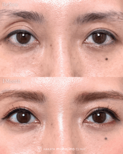 眼瞼下垂症手術