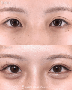 もへじの自然癒着法