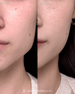 エラボトックス