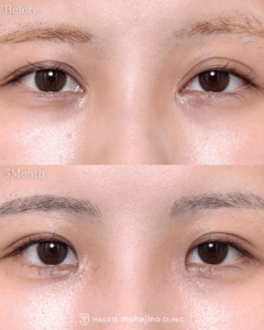 蒙古ひだ形成術(目頭切開修正)+他院埋没抜糸+線留め