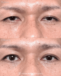 眼瞼下垂症手術