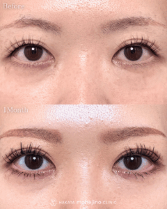 他院埋没法抜糸+もへじの自然癒着法