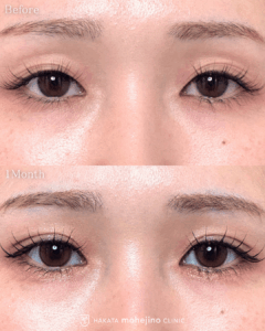 もへじの自然癒着法