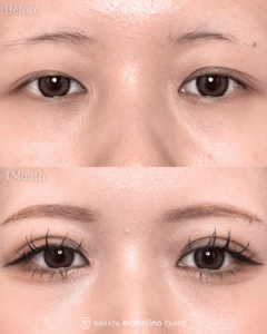 もへじの自然癒着法