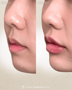 唇ヒアルロン酸×顎ヒアルロン酸