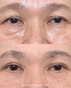 表ハムラ法+眉下リフト