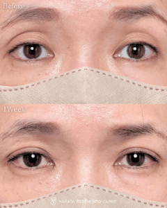 切らない眼瞼下垂手術(埋没式眼瞼下垂手術)