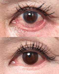 下眼瞼外反修正(lateral canthopexy+眼輪筋引き上げ)