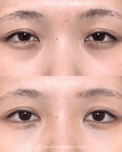 傷の目立ちにくい目頭切開Z法