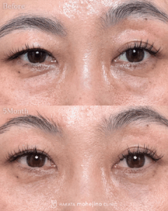 眉上リフト+表に傷のない目の下のふくらみ取り