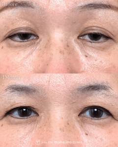 眼瞼下垂症手術