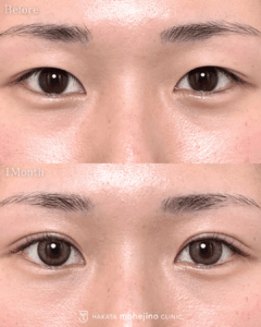 シークレットもへじの自然癒着法