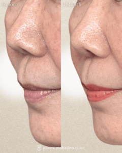 鼻柱下降術+鼻柱基部軟骨移植(猫手術)