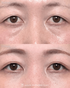 表に傷のない目の下のふくらみ取り+脂肪注入(目の下)+認定脂肪製剤作成