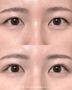 シークレットもへじの自然癒着法