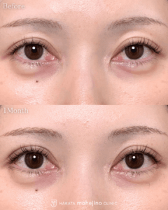 シークレットもへじの自然癒着法+目尻切開(タレ目尻切開)