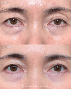 眼瞼下垂症手術(挙筋腱膜前転法)