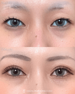 もへじの自然癒着法