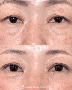 もへじの自然癒着法+表に傷のない目の下のふくらみ取り