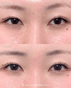 目尻切開(タレ目尻切開)