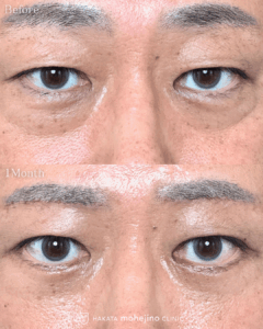 表ハムラ法+眉下リフト