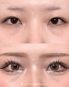 シークレットもへじの自然癒着法+傷の目立ちにくい目頭切開Z法