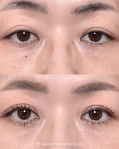 眼瞼下垂症手術