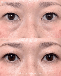 表に傷のない目の下のふくらみ取り+脂肪注入(目の下)+認定脂肪製剤作成