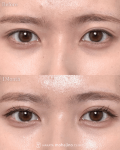 シークレットもへじの自然癒着法