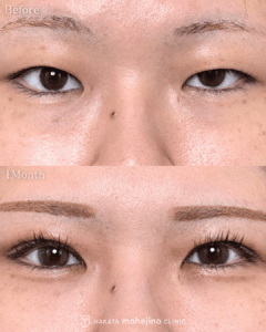 眼瞼下垂/二重切開