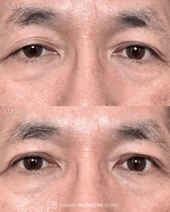 眼瞼下垂/二重切開