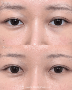 シークレットもへじの自然癒着法(右眼のみ)