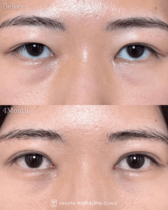 目周り複合施術