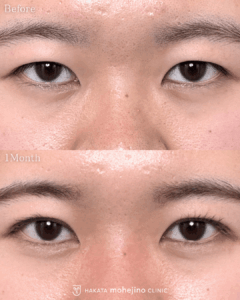 もへじの自然癒着法