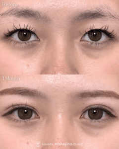 もへじの自然癒着法