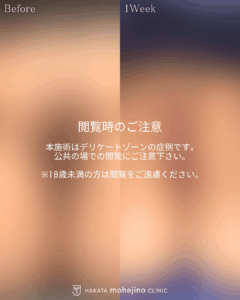 小陰唇縮小+副皮縮小