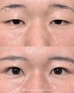 眼瞼下垂/二重切開