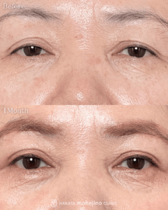 眼瞼下垂症手術