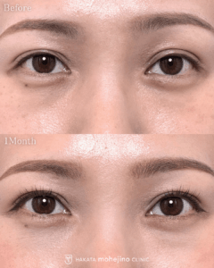 眼瞼下垂/二重切開+逆さまつげ手術(Hotz変法)左眼のみ