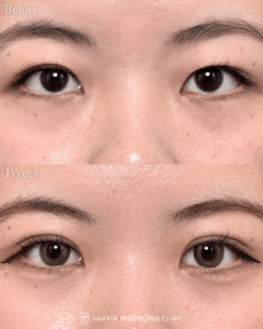 もへじの自然癒着法