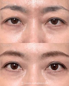 眼瞼下垂症手術