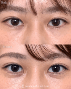 切らない涙袋形成術