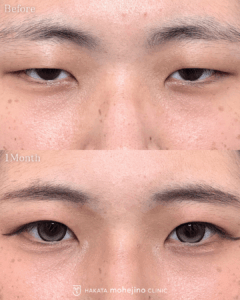 眼瞼下垂症手術(挙筋腱膜前転法)