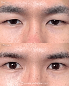 眼瞼下垂症手術(眉下切開法)
